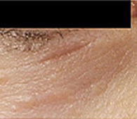 Syringomas under eye before treatment - San Diego Dermatology and Laser Surgery