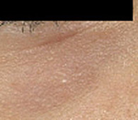 Syringomas under eye after treatment - San Diego Dermatology and Laser Surgery