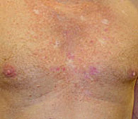 precancerous AK's before treatment - San Diego Dermatology and Laser Surgery