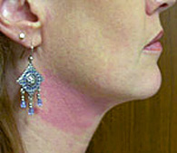 After Thermage skin tightening - San Diego Dermatology and Laser Surgery