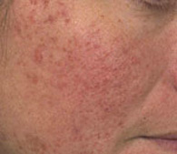 Rosacea before treatment - San Diego Dermatology and Laser Surgery