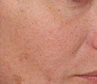 Rosacea  after treatment - San Diego Dermatology and Laser Surgery