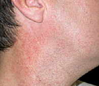 Redness on neck  before treatment - San Diego Dermatology and Laser Surgery