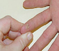 Wart on finger  before treatment - San Diego Dermatology and Laser Surgery
