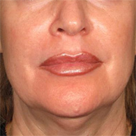 Before Ultherapy skin tightening - San Diego Dermatology and Laser Surgery