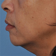 Before Ultherapy skin tightening - San Diego Dermatology and Laser Surgery