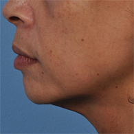 After Ultherapy skin tightening - San Diego Dermatology and Laser Surgery