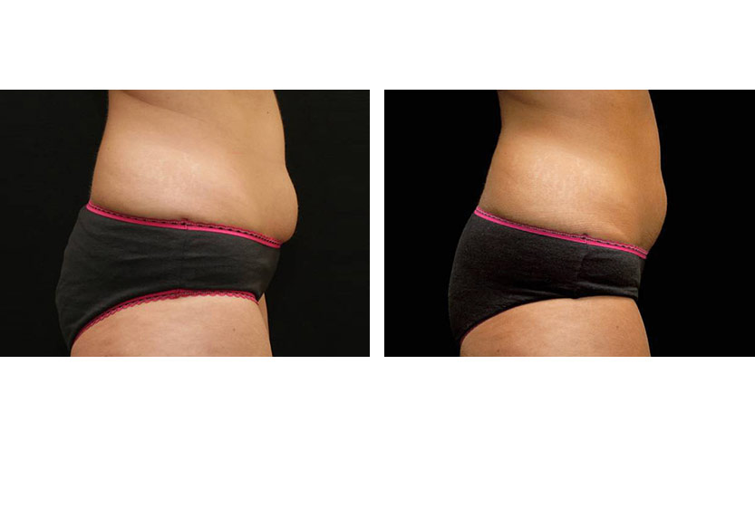 Non-Surgical Fat Removal Review - Vanquish Liposuction Results