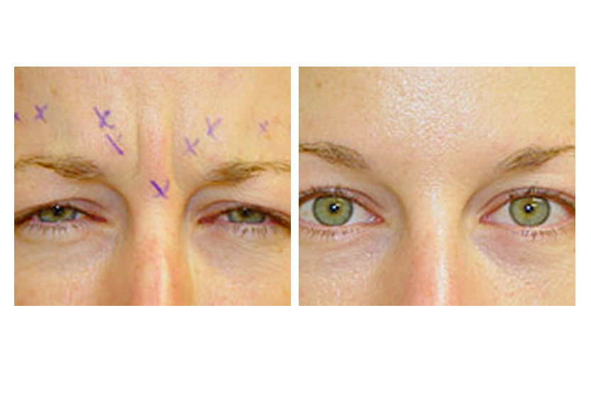 botox before dysport laser injections