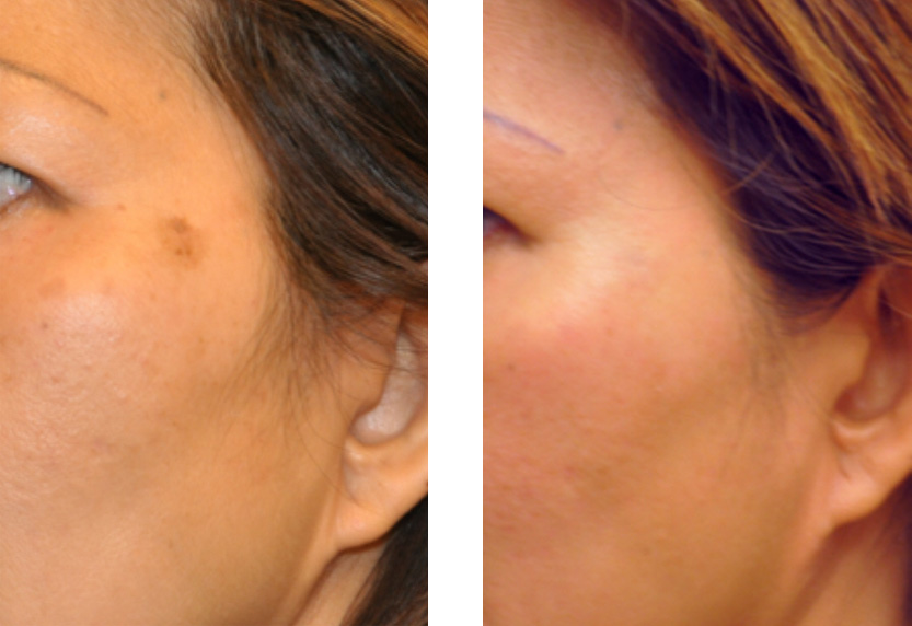 Brown Spots Age Spots And Tattoo Removal San Diego Dermatology And 