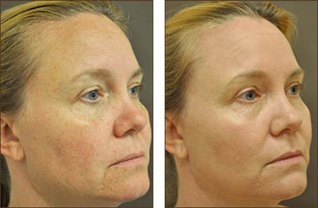 Pixel C02 Before and After Picture