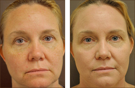 Pixel C02 Before and After Picture