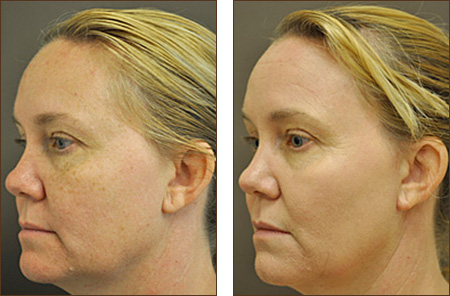 Pixel C02 Before and After Picture