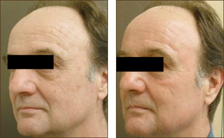 Pixel C02 Before and After Picture