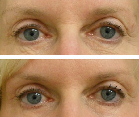 Pixel C02 Before and After Picture