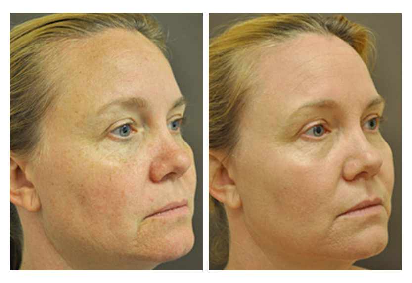 CO2 Laser Skin Resurfacing