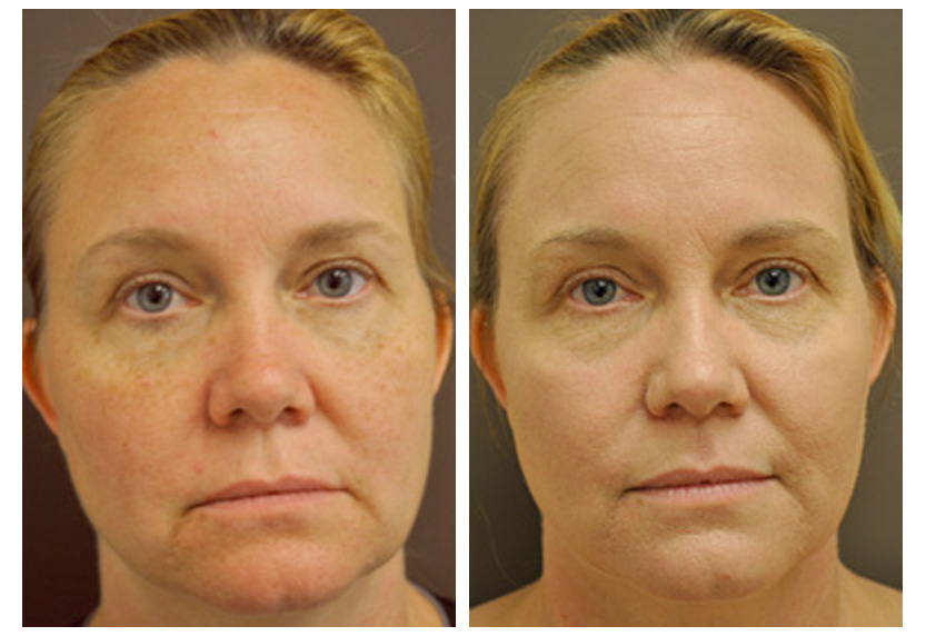 CO2 Laser Facial Rejuvenation: Fix Fine Lines, Wrinkles, Sun Damage &  Stretch Marks