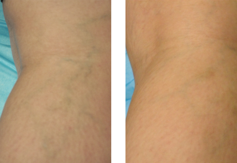 Sclerotherapy Vein Treatment | San Diego Spider and Varicose Veins