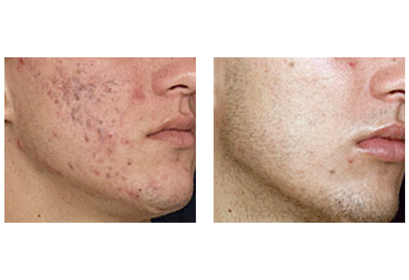 Laser Acne Treatment Blu U Lasers San Diego Ca