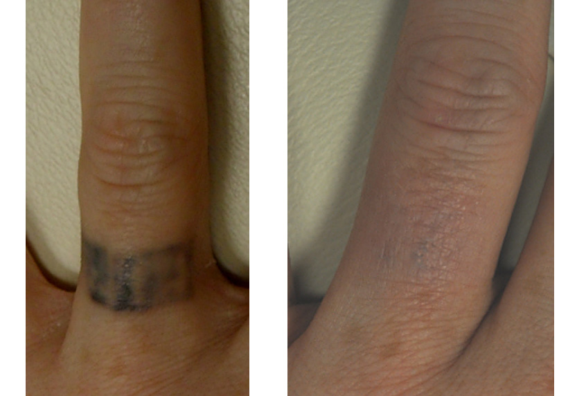 Laser Tattoo Removal Encinitas | Aesthetically Pleasing Medical Spa