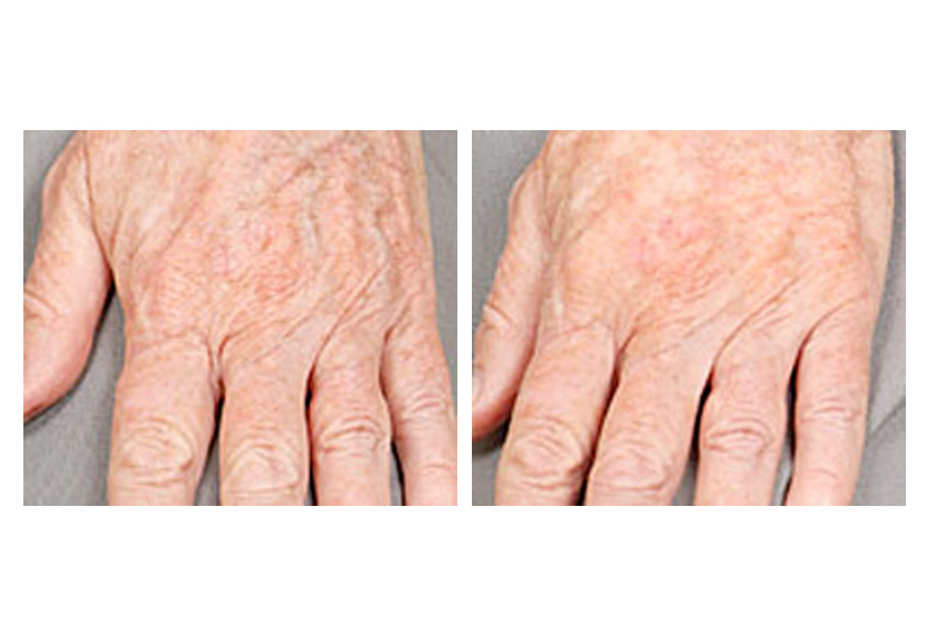 Hand Rejuvenation Brown Spots Liver Spots Veins San Diego Laser