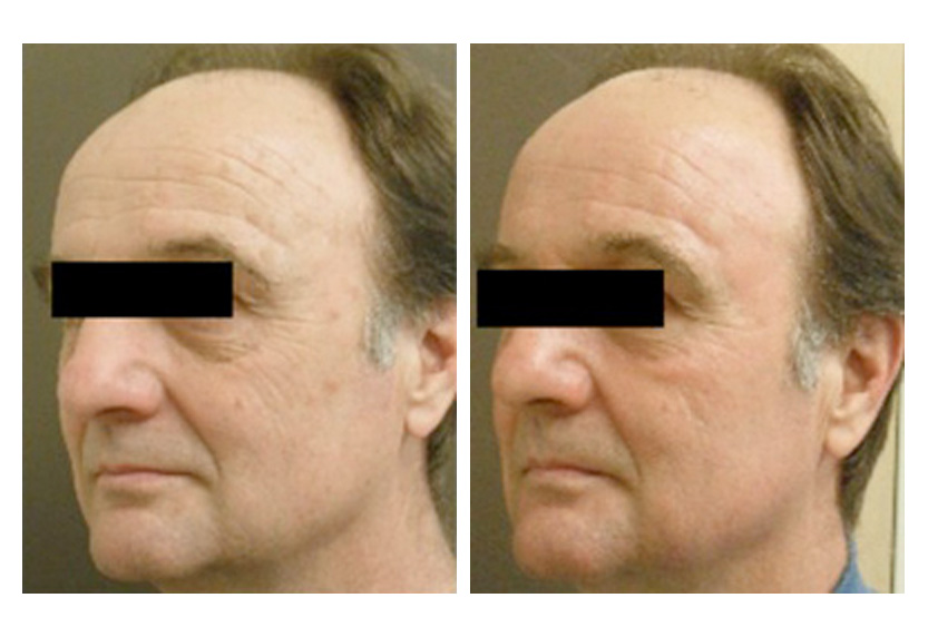 Fractional Co2 Laser Skin Resurfacing Wrinkles Sun Damage San Diego